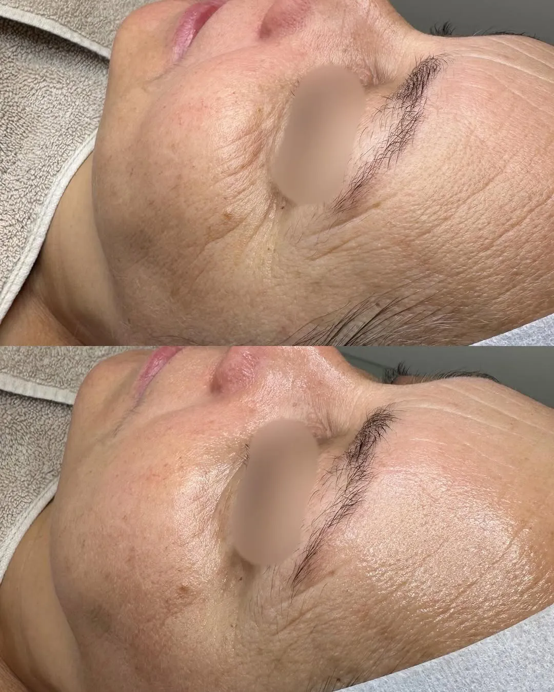 Sejas āda pirms un pēc THESERA 42 Red Collagen procedūras